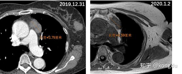 胸腺退化不全是什么意思,ct表现,跟胸腺残留,胸腺增生或胸腺瘤有什么