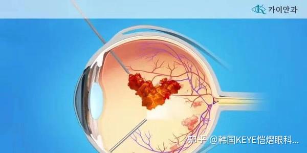 视网膜脱落,视网膜疾患治疗的几种方法