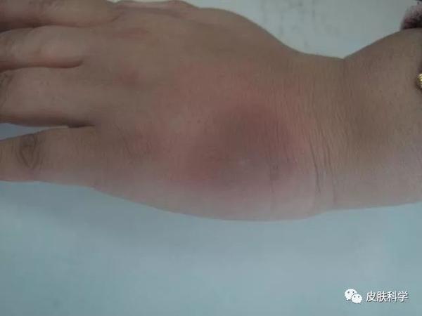 二,猩红热型(麻疹样)药疹:皮损为散在大量红斑,分布全身,起病迅速.