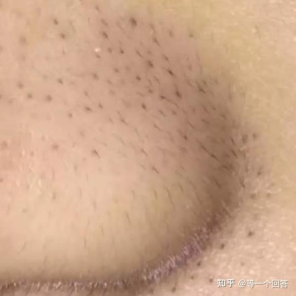 也就是鼻子上的黑点,只有一种是皮肤学上所说的黑头粉刺,还有两种比较