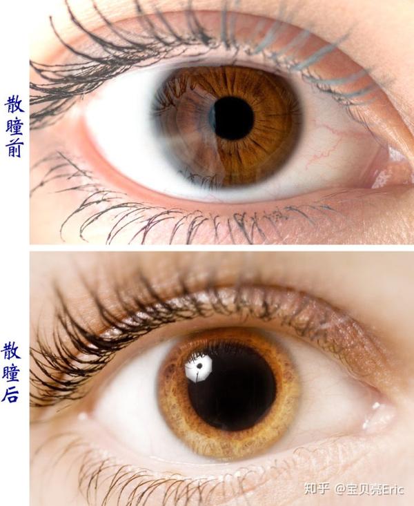 弱视散瞳验光究其原理是利用药物的药性对支配瞳孔括约肌和开大肌的