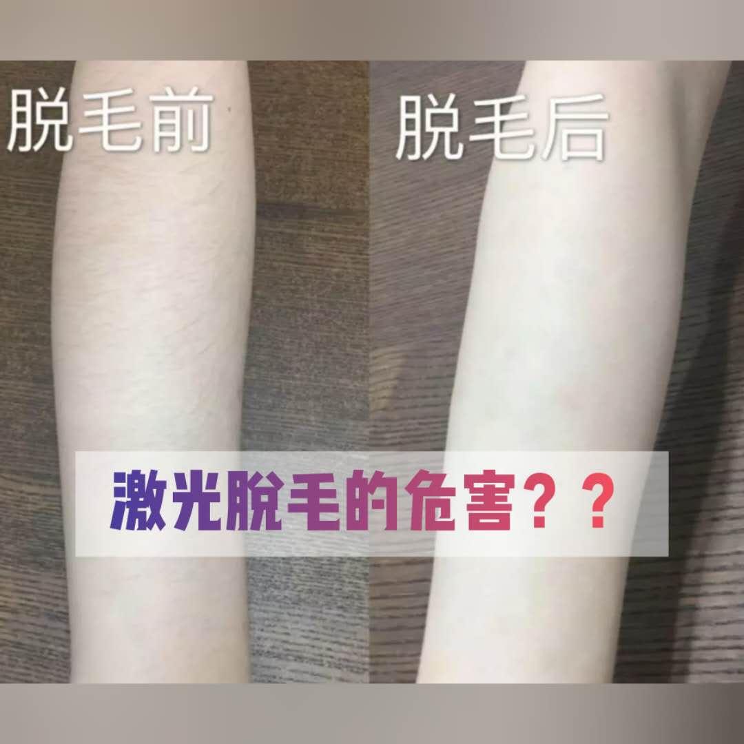 激光脱毛会影响皮肤正常代谢和排汗吗