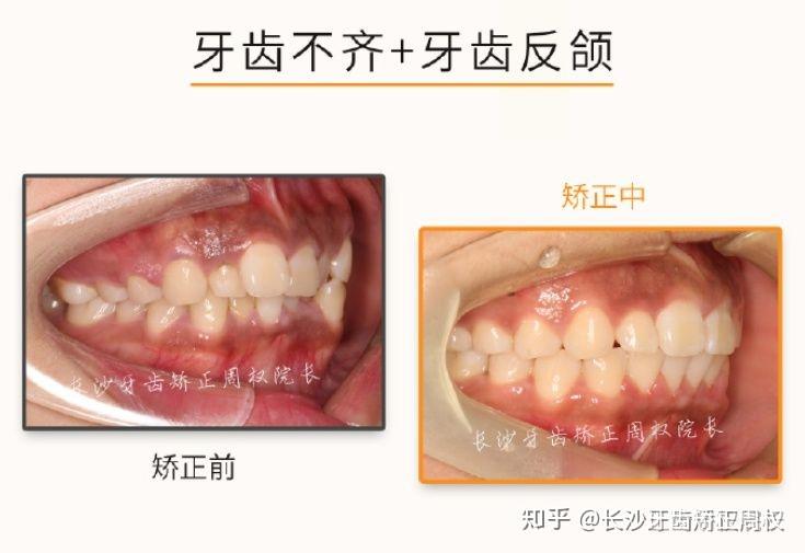 长沙隐形矫正: 牙齿不齐 个别牙齿反颌>