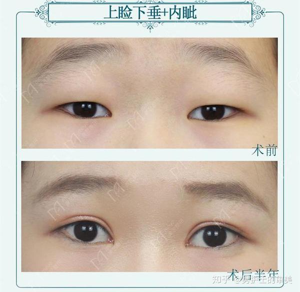 郑州肿眼泡小姑娘做了全切双眼皮术后半年眼睛大了一倍还多
