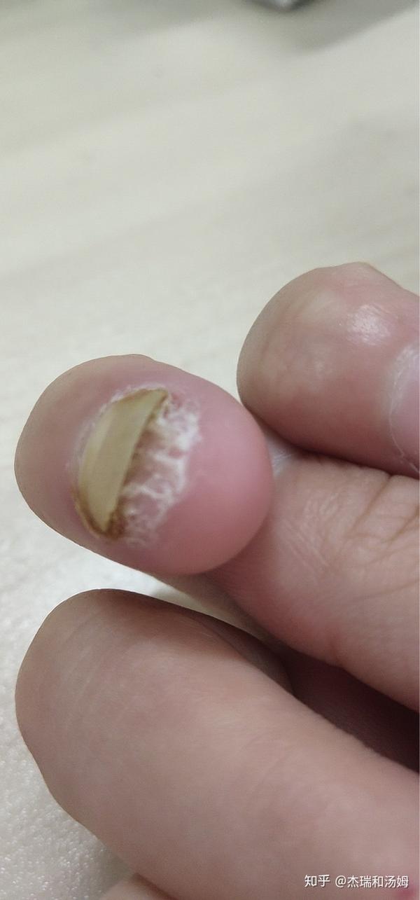 镂空的灰指甲也比较好处理,分离后注意坚持抗菌杀菌即可