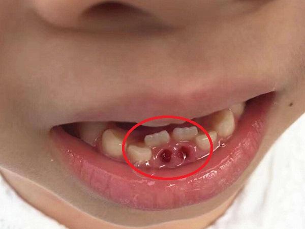 "儿童换牙期护理,需注意这5个方面