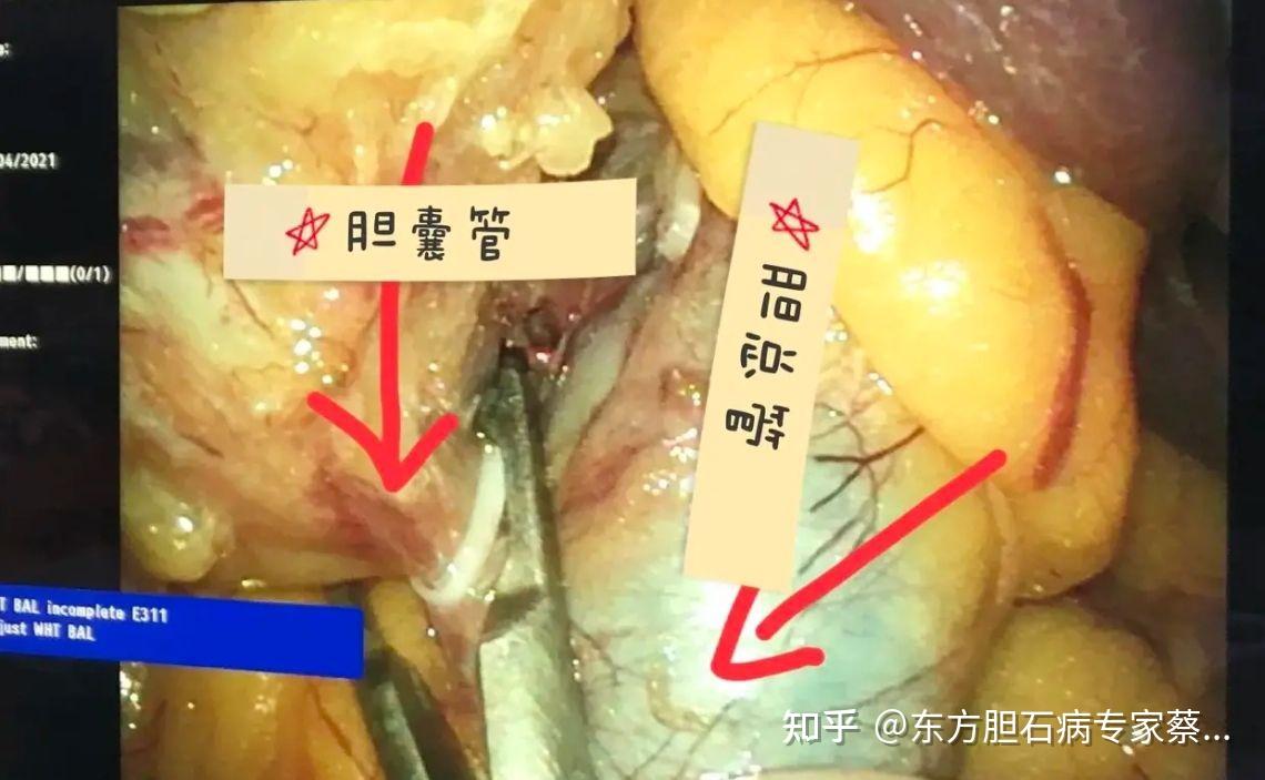 经脐单孔腹腔镜胆囊切除手术