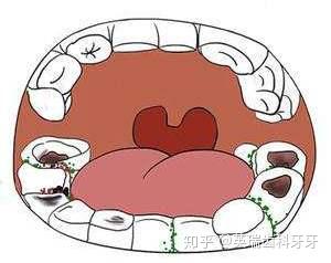 龋齿也叫蛀牙,是儿童口腔问题之一,儿童总爱吃甜食而且不注意口腔清洁