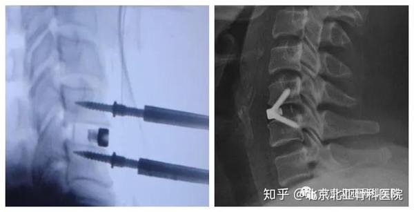 颈前路零切迹(zero-plant,zero-p)椎间融合固定治疗脊髓型颈椎病!