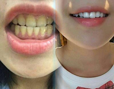 想牙齿变白,那也得选对方法