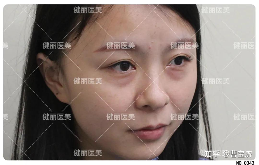 按摩能去眼袋泪沟看完你就明白