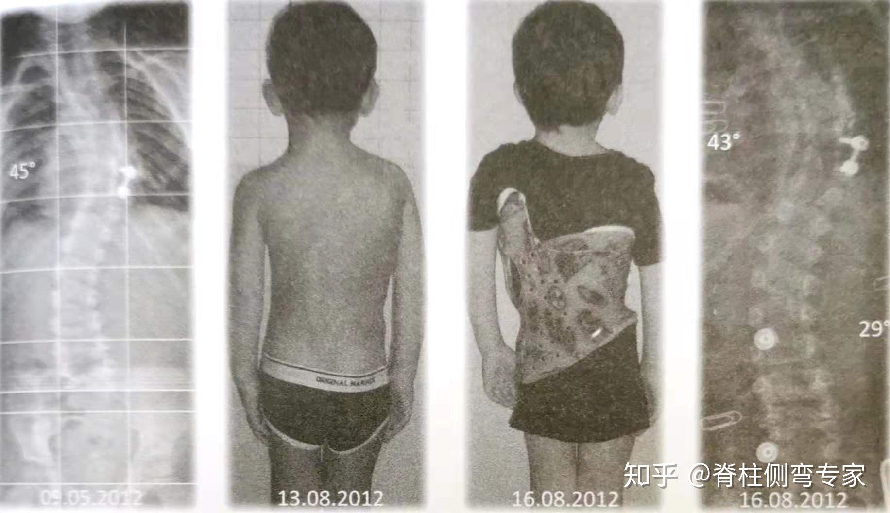 图2和图3是一个患有先天性脊柱侧弯的儿童,他的侧凸在手术后持续恶化.