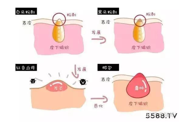 闭口粉刺痘痘三者有什么关系呢