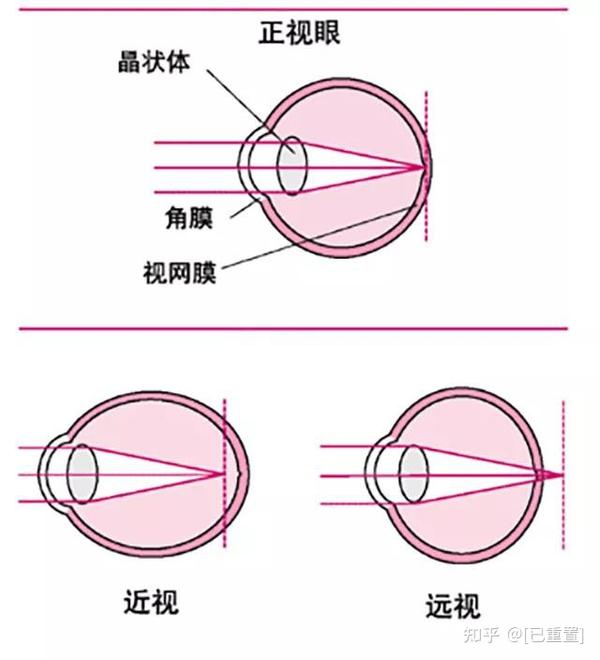 摩睛科普:近视眼与远视眼的区别!