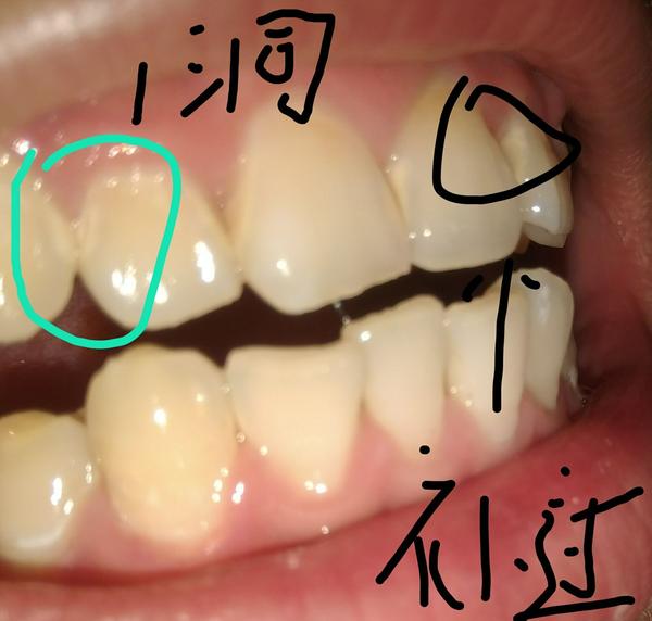 第三张图就更明白了,乳切牙已经坏掉一半了,乳尖牙上面大块的白垩色.