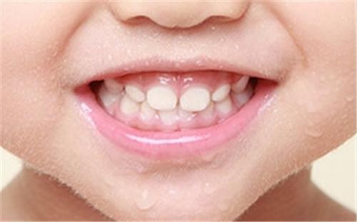 儿童牙齿正畸的费用是多少看完这篇文章你就会了解