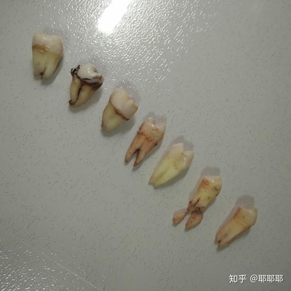 25 岁前去矫正牙齿(戴牙套)是什么体验?