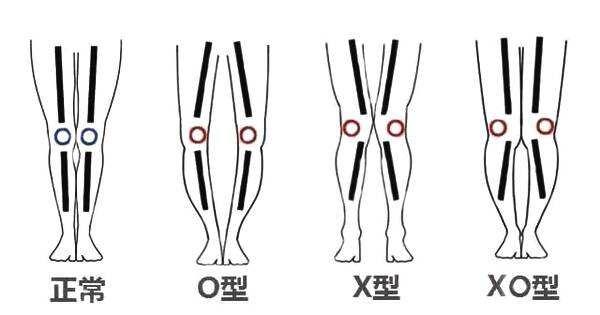 到底什么才是xo型腿