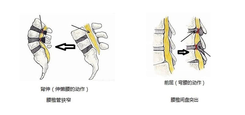如何治疗椎管狭窄