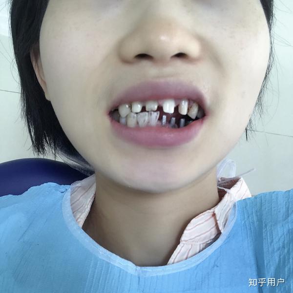 有没有整牙后变更丑的案例?