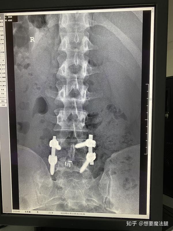 记录下 腰椎间盘固定融合手术