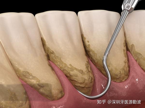 通过对牙齿的洁治,龈下刮治去除牙齿周围的牙石,菌斑等引起炎症的东西