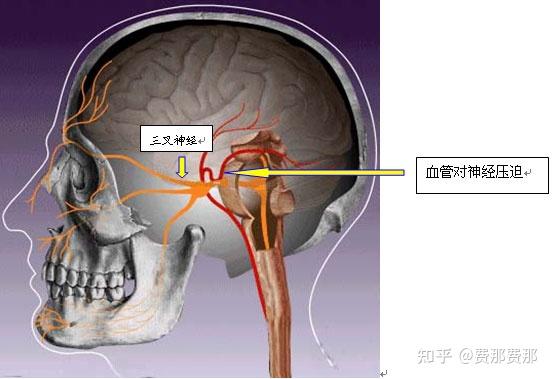 三叉神经手术有什么风险吗