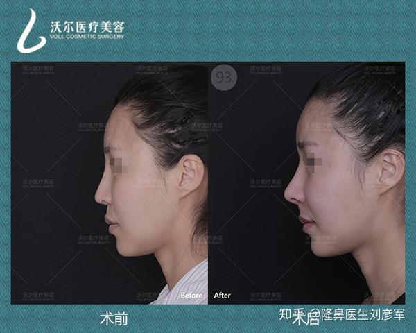 术前术后对比:加入自体鼻基底填充,锦上添花