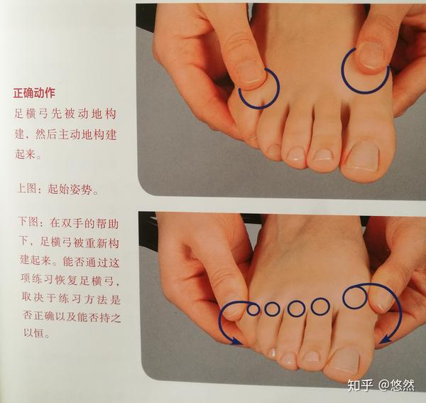 以上方法适用于轻度拇外翻,足外翻和足弓塌陷(功能性扁平足),足旋前