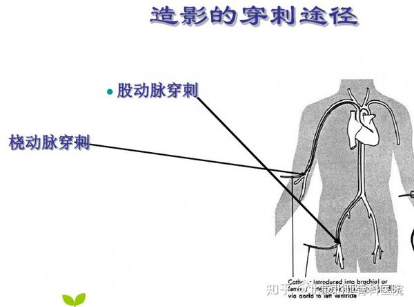 2,经股动脉入路者,盐袋压迫4-6小时,穿侧肢体制动12小时后可在床上