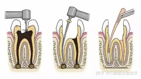 医生让做根管治疗,是不是被忽悠了