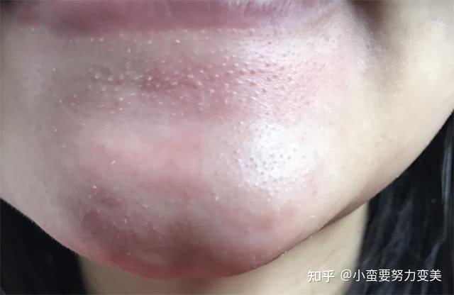 下巴上一颗颗白色小点点怎么回事