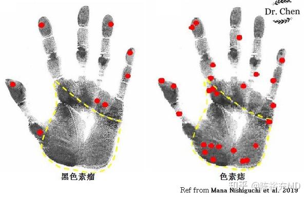 左图红点代表黑色素瘤,右图红点代表色素痣.