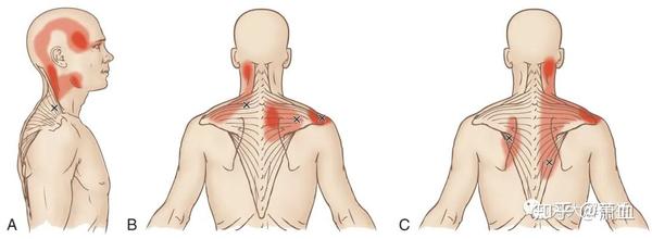 它宽而薄的纤维铺布于肩关节,附着于枕骨,锁骨外侧,肩胛骨和胸椎棘突.