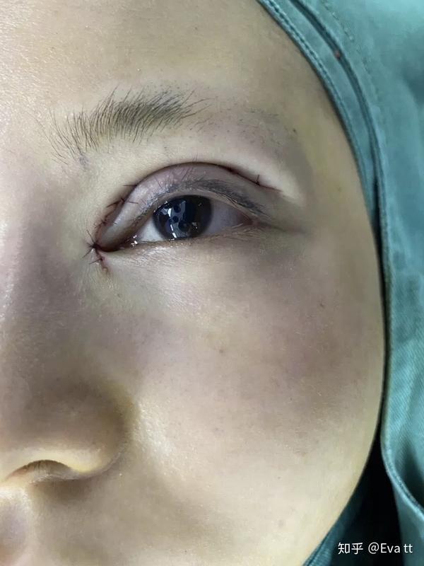 人生中第一次眼综合全切上睑下垂
