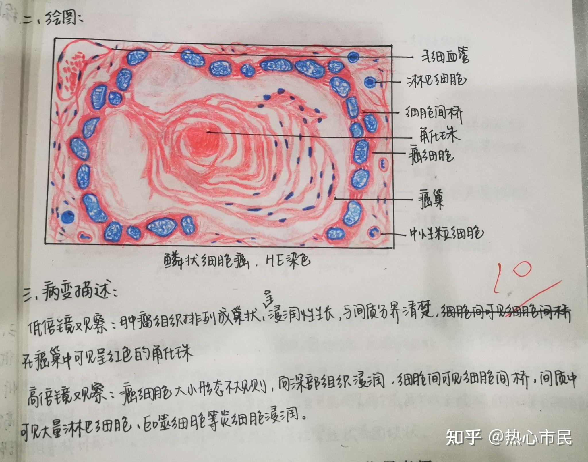 病理学红蓝铅笔手绘图实验报告病变描述