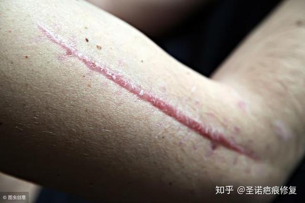 疤痕是怎样形成的?搞清这5种类型的疤痕,就了然于心