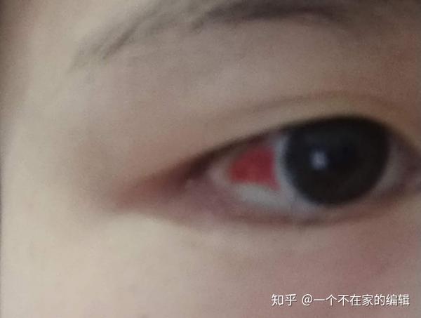 半飞秒激光近视手术20205月术后恢复日志