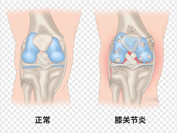 健康科普 且行且珍膝膝关节炎科普 知乎