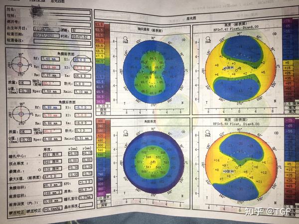 麻烦专业人士帮我看下角膜地形图,rgp的bc和d还有度数