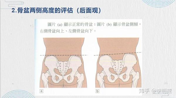 长期形成不良姿势习惯等, 骨盆前倾,骨盆后倾,骨盆旋转,骨盆侧倾等