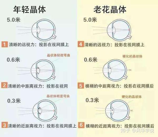 近视老花为什么不可以抵消就是这个原因