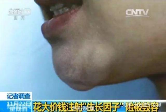 表皮生长因子egf有哪些护肤功效