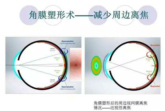 何为角膜塑形镜