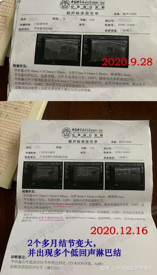 定期观察下的甲状腺结节发生了什么变化附检查报告对比图