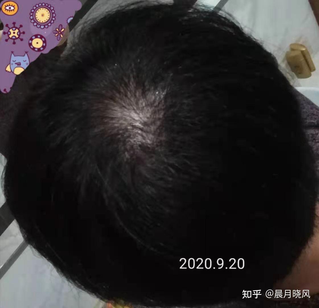 头发得了脂溢性皮炎怎么办啊三天不洗就掉很多跟