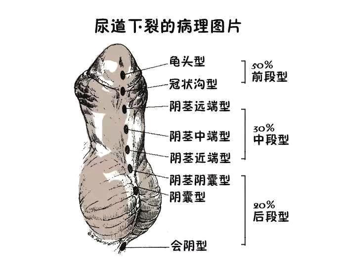 尿道下裂分为哪几种情况