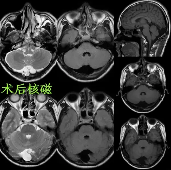 制定出神经内镜下行后颅窝开颅枕大池蛛网膜囊肿脑池联通术的手术方案