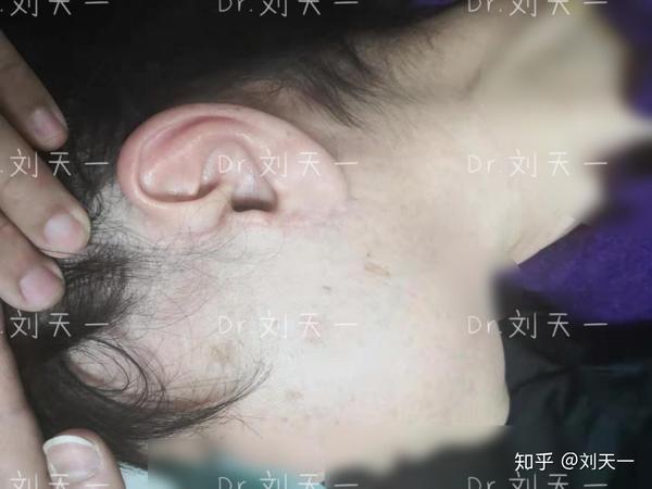 原创面部提升不留疤传说中的医用胶水真的有那么神奇吗