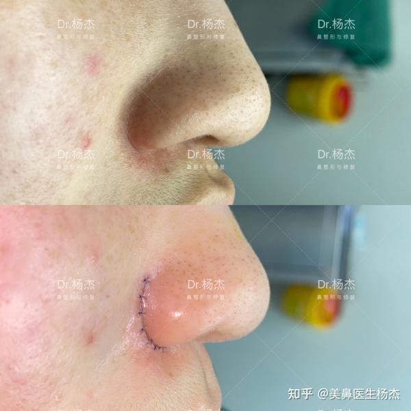 鼻翼缩小外切 内切
